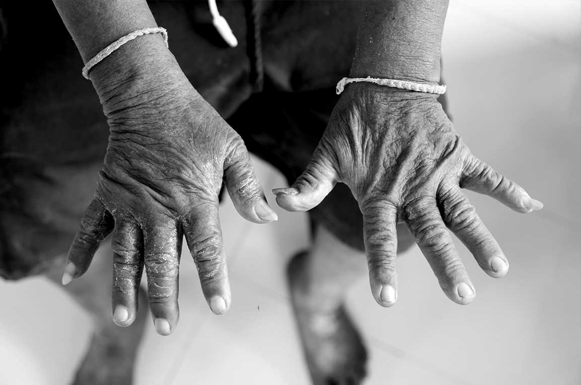 Scleroderma Clinical Study