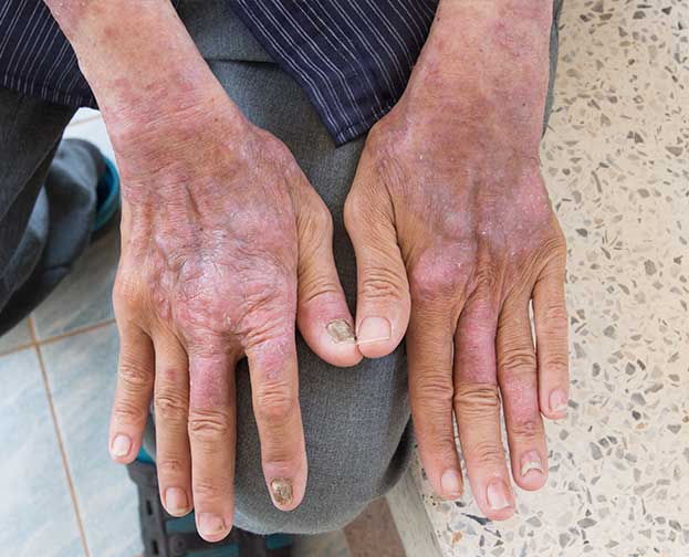 scleroderma-clinical-study A person with Scleroderma on his hands participates in a clinical research study
