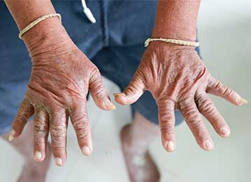 Person participating in a Scleroderma Clinical Trial at CRWF