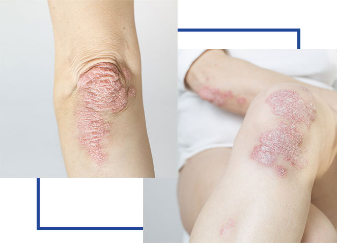 psoriatic-arthritis