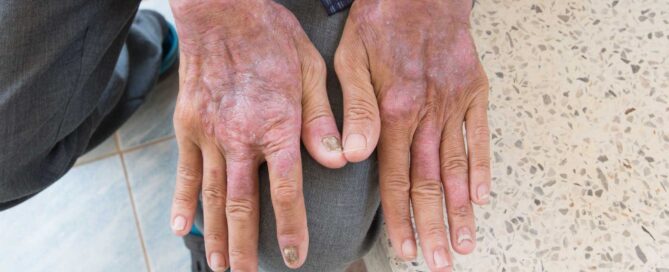 Patient with Scleroderma, Systemic Sclerosis affecting the hands in a clinical trial