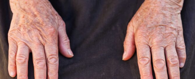 Psoriatic Arthritis study at CRWF